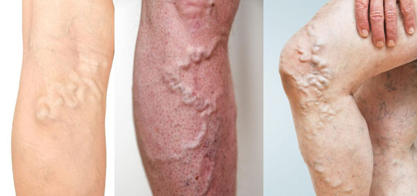 Deep Vein Thrombosis